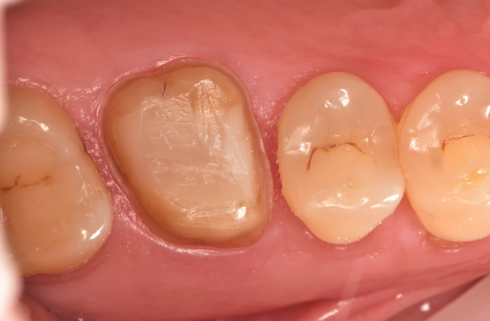 Detailní záběr na nabroušený zub na schůdek před osazením estetickou keramickou korunkou.