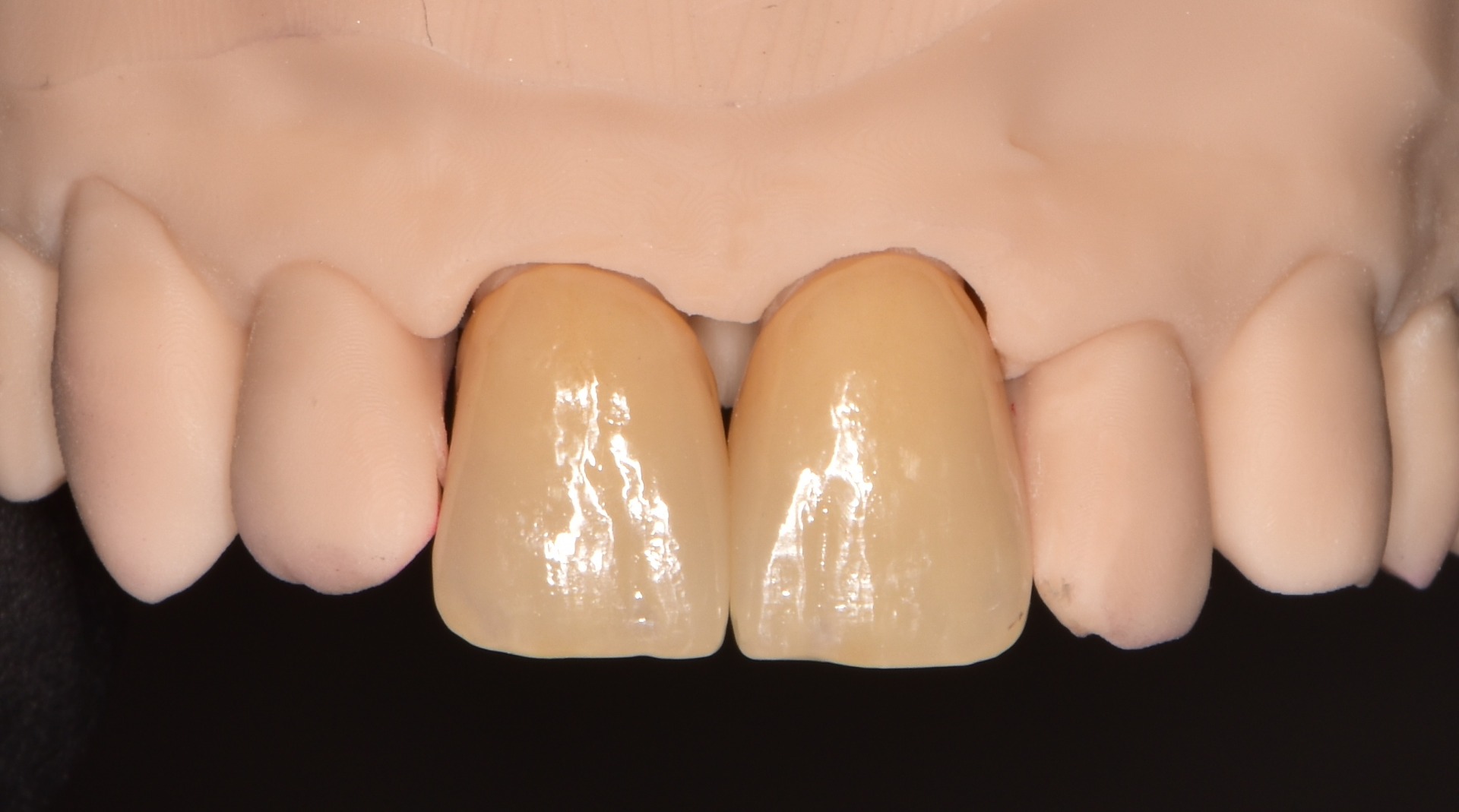 nové estetické korunky na 3D tištěném modelu